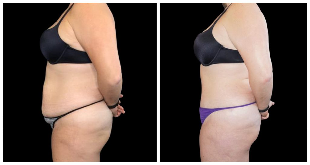 Tummy Tuck London Ontario before and after result