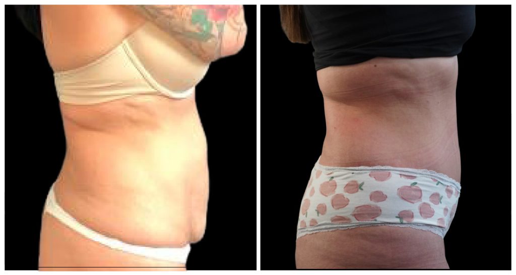 Tummy Tuck London Ontario before and after result