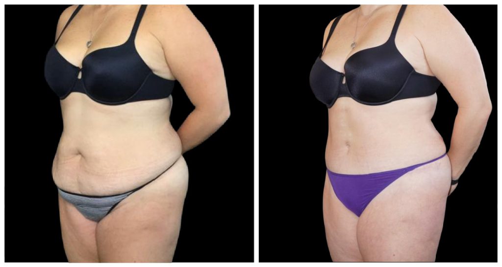 Tummy Tuck London Ontario before and after result