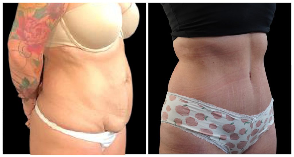 Tummy Tuck London Ontario before and after result