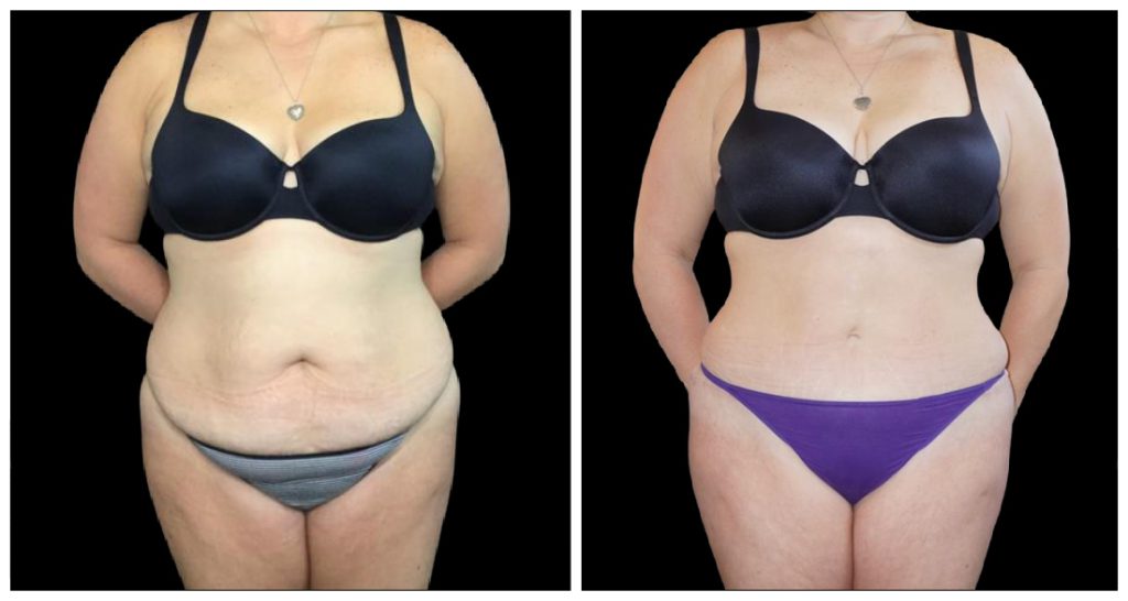 Tummy Tuck London Ontario before and after result