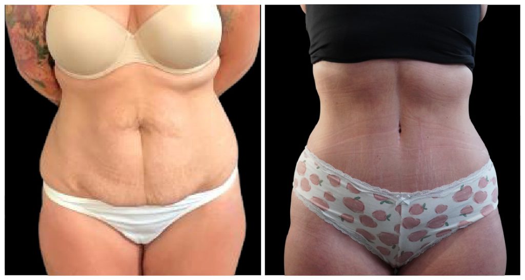 Tummy Tuck London Ontario before and after result