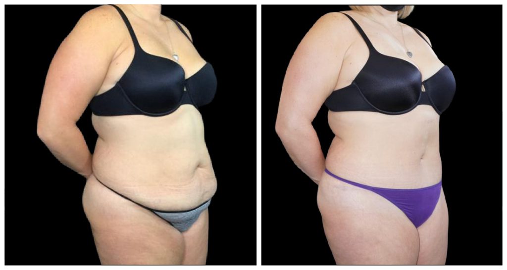 Tummy Tuck London Ontario before and after result