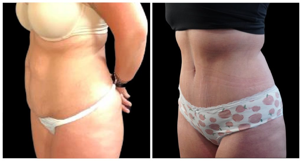 Tummy Tuck London Ontario before and after result