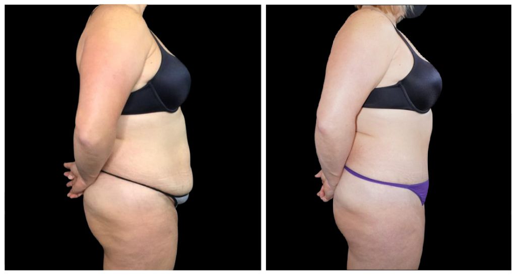 Tummy Tuck London Ontario before and after result