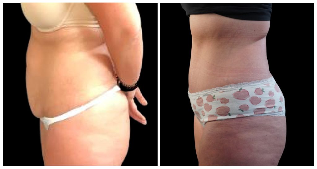 Tummy Tuck London Ontario before and after result