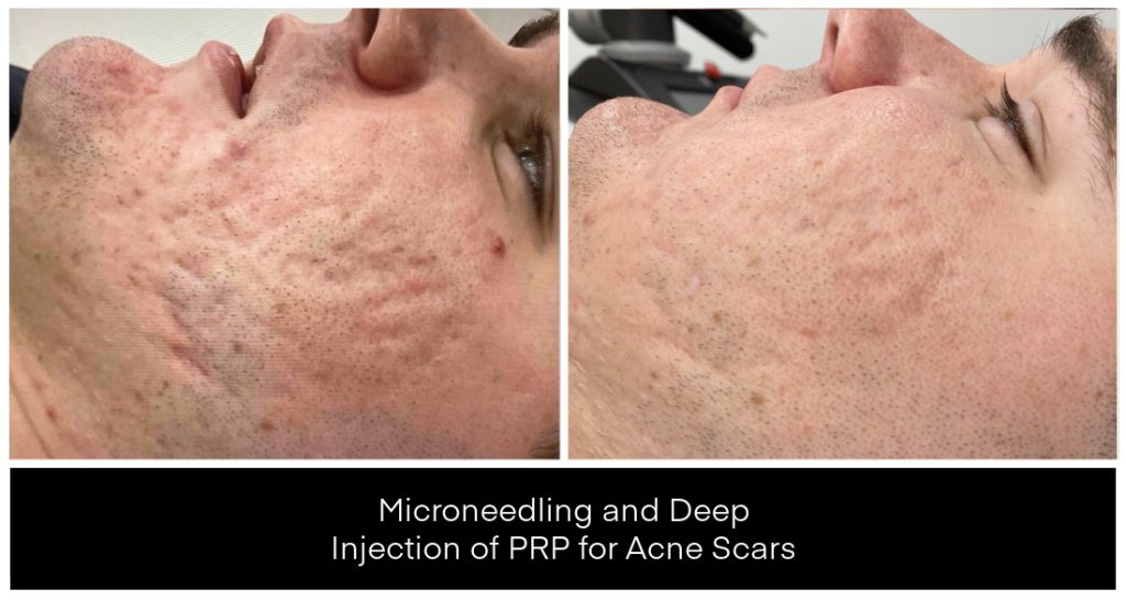 Side-by-side close-up of a male cheek showing acne scar texture before and after microneedling with PRP at Yazdani Aesthetics in London Ontario, displaying redness and improved skin texture