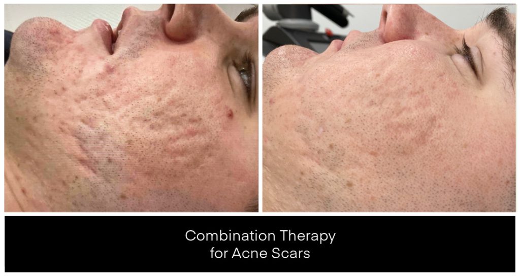 Yazdani Aesthetics acne scar treatment showcase with close-up side profiles of a patient’s facial skin showing reduced acne scars and improved texture, Vivier V-Stat gel referenced