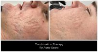 Yazdani Aesthetics acne scar treatment showcase with close-up side profiles of a patient’s facial skin showing reduced acne scars and improved texture, Vivier V-Stat gel referenced