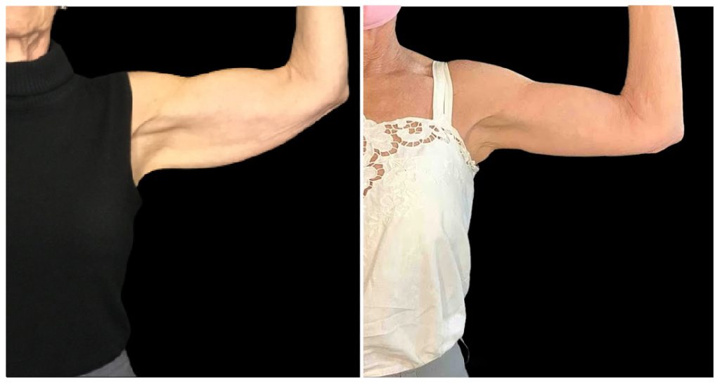 Arm Lift in London Ontario before and after result