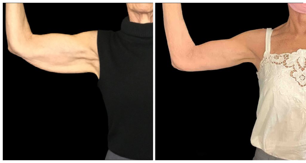Arm Lift in London Ontario before and after result