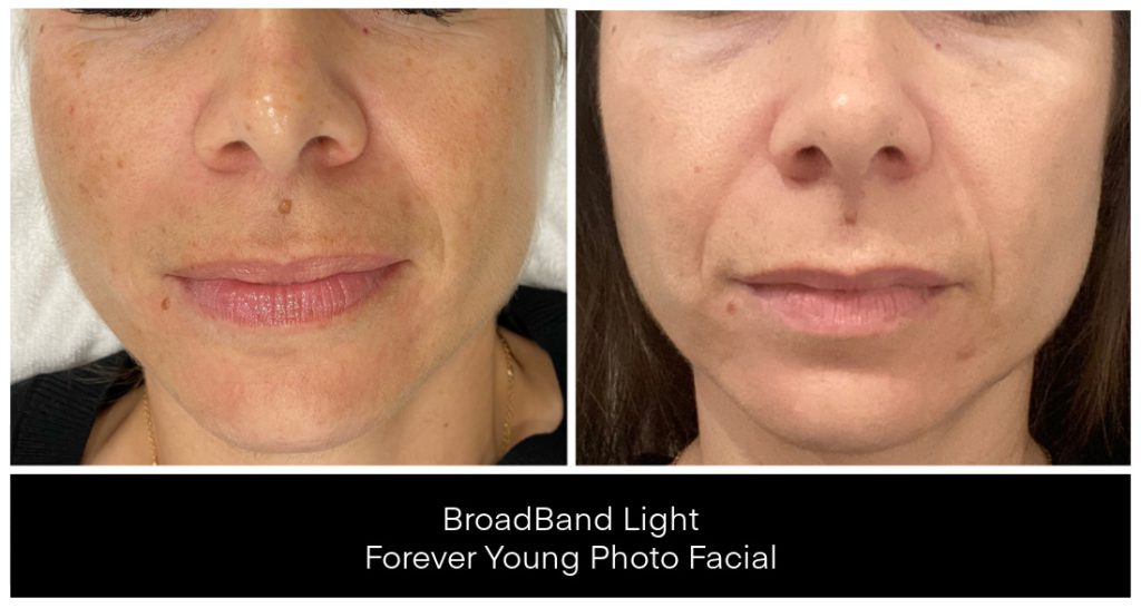 Laser Treatments for Redness before and after result
