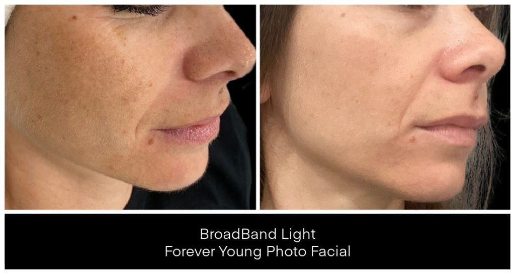 Laser Treatments for Redness before and after result