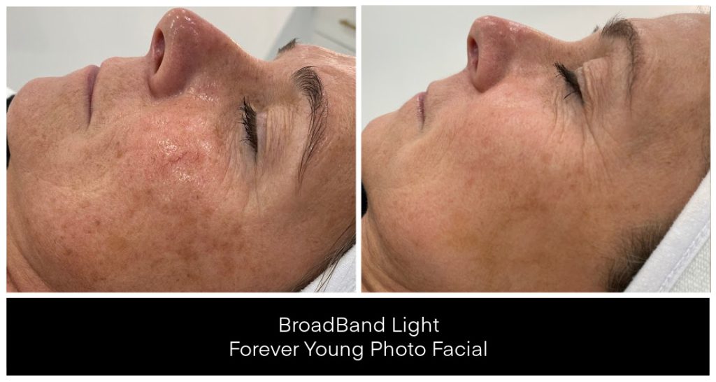 Before and after images showing skin treatment results with BroadBand Light for a photo facial, highlighting changes in skin tone and texture.