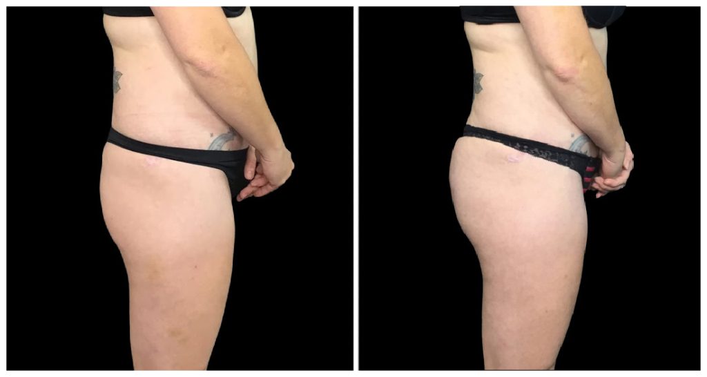 Brazilian Butt Lift before and after result