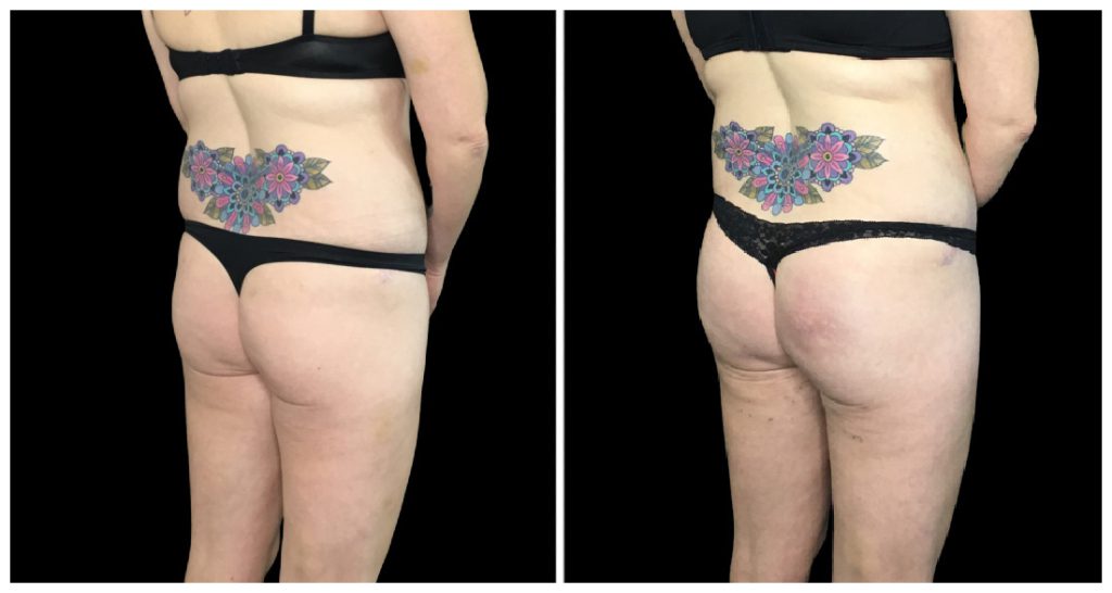Brazilian Butt Lift before and after result