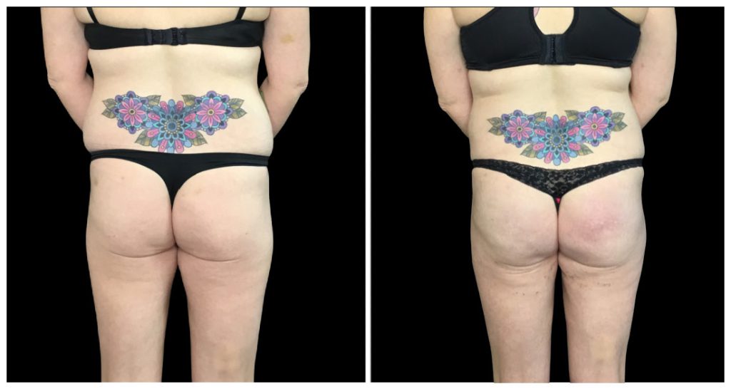 Brazilian Butt Lift before and after result