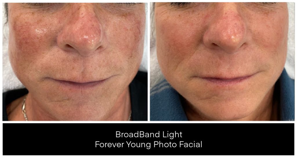 Before and after images showing facial skin improvement from a BroadBand Light Forever Young Photo Facial treatment.