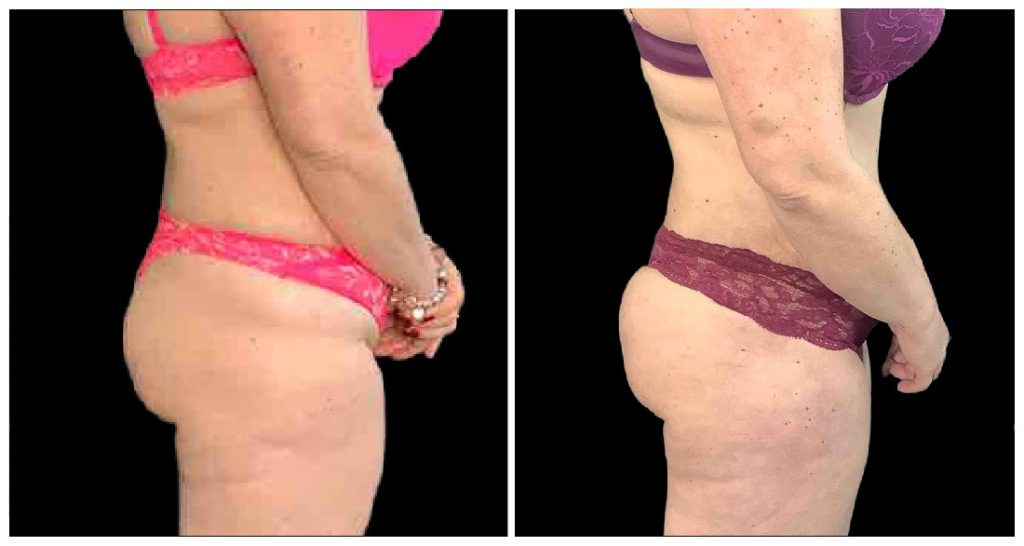 Brazilian Butt Lift before and after result