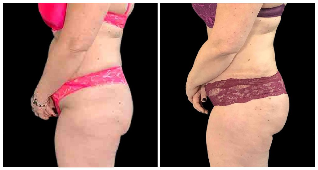 Brazilian Butt Lift before and after result