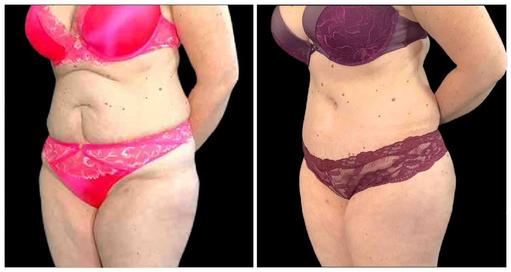 Brazilian Butt Lift before and after result