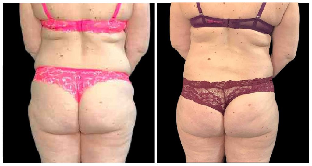 Brazilian Butt Lift before and after result