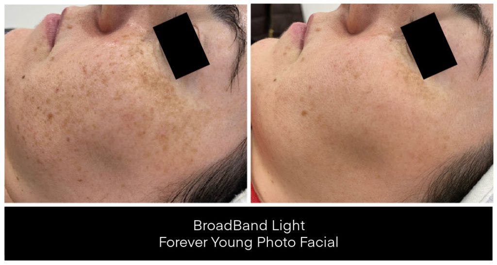 Before and after images showing skin treatment results on a person's face, highlighting changes in skin tone and texture.
