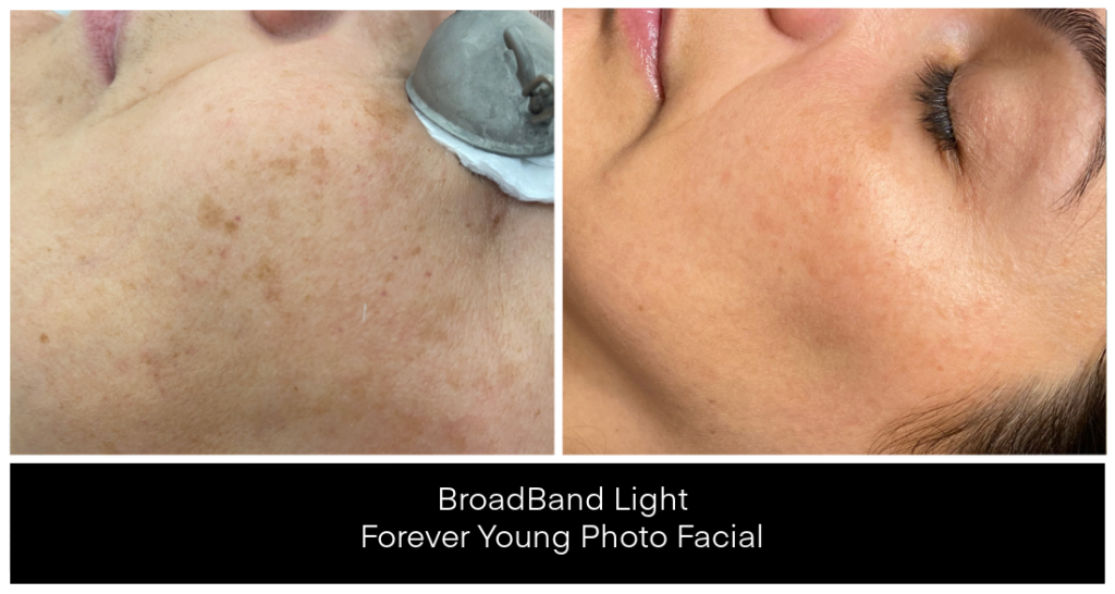Laser Treatments for Redness before and after result
