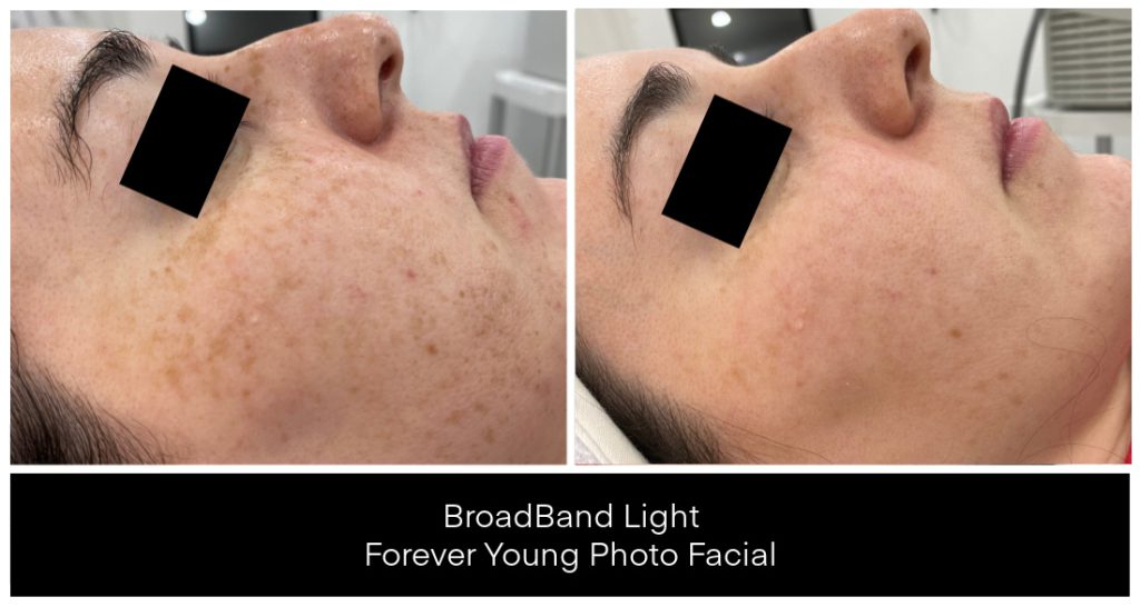 Before and after images showing skin treatment results with BroadBand Light for a photo facial, highlighting changes in skin texture and pigmentation.