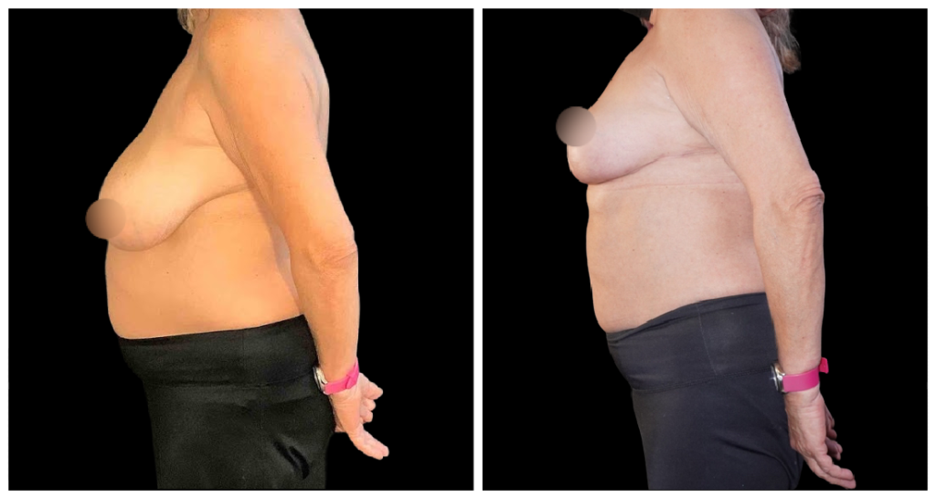 Breast Reduction before and after result
