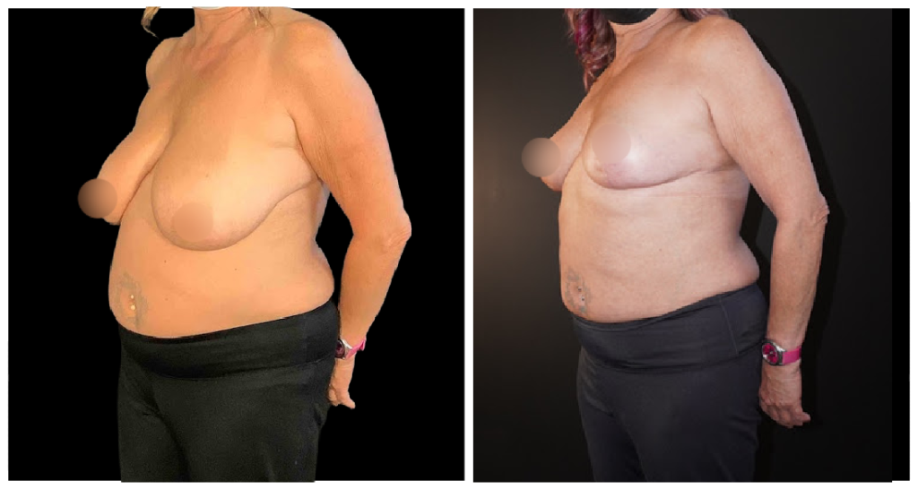 Breast Reduction before and after result