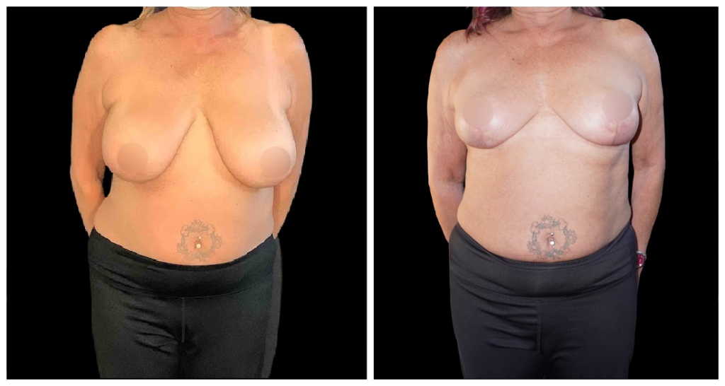 Breast Reduction before and after result