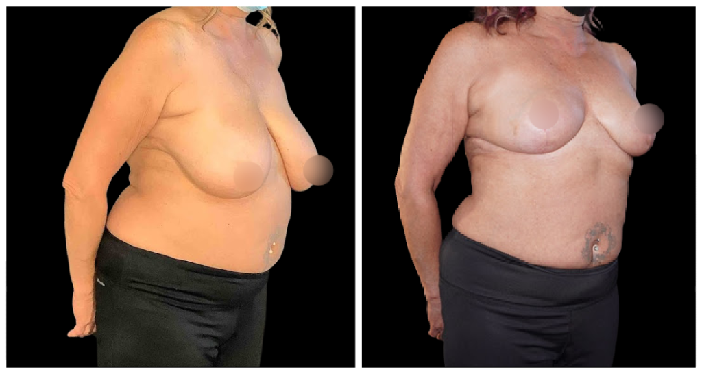 Breast Reduction before and after result