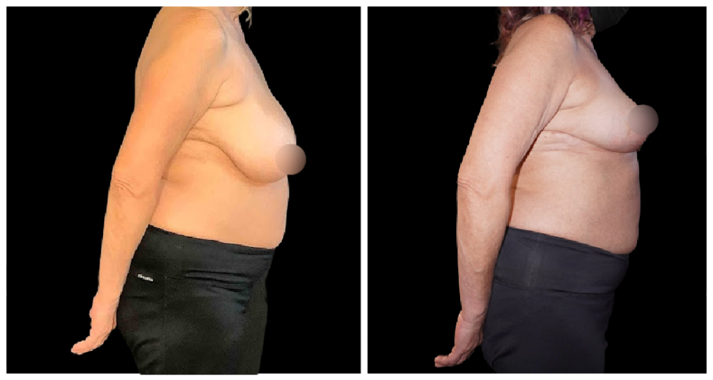 Breast Reduction before and after result