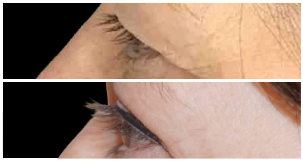 Eyelid Rejuvenation (Blepharoplasty) before and after result