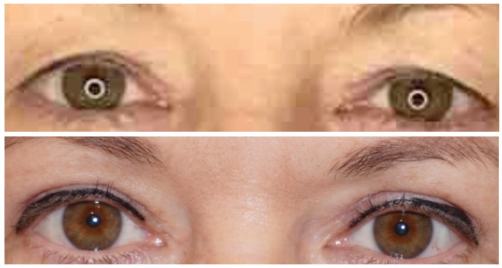 Eyelid Rejuvenation (Blepharoplasty) before and after result