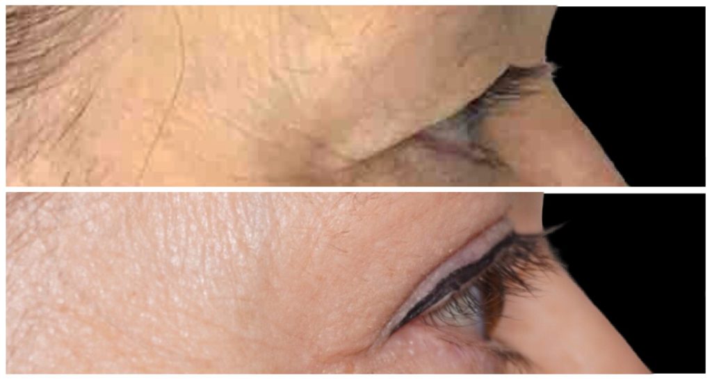 Eyelid Rejuvenation (Blepharoplasty) before and after result