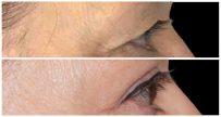 Eyelid Rejuvenation (Blepharoplasty) before and after result