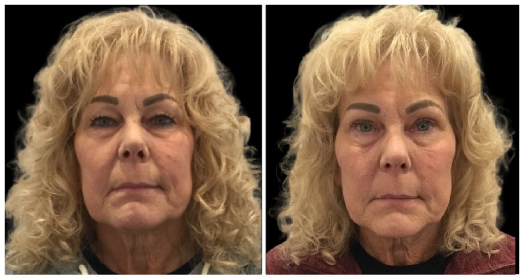 Before and after images of a patient showcasing the effects of blepharoplasty, highlighting changes in eyelid appearance and facial features.