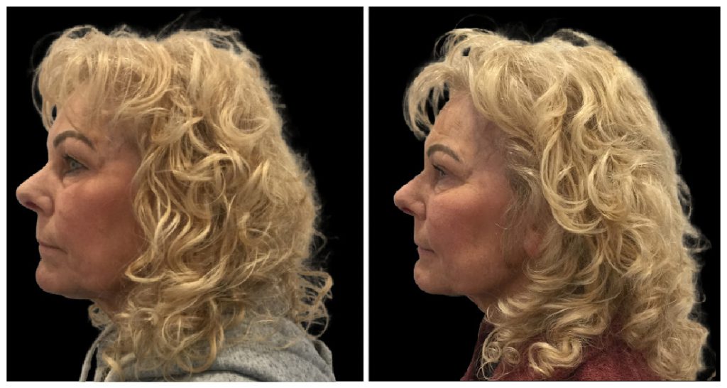 Profile view of a woman with curly blonde hair, showing before and after results of a cosmetic procedure.