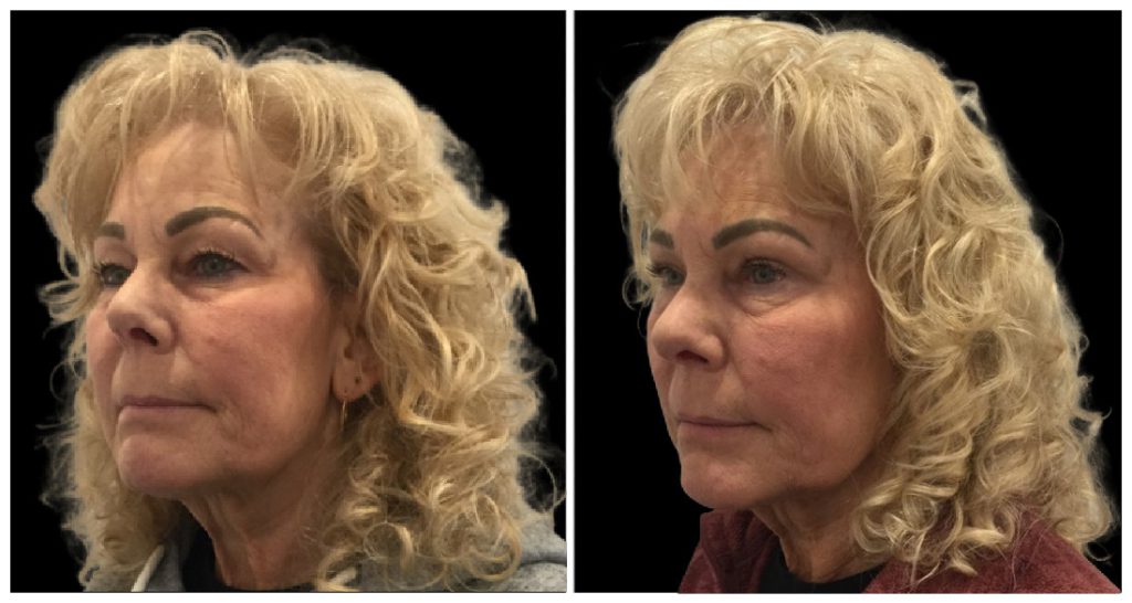 Before and after images of a woman's face showing changes in eyelid appearance and skin texture from a cosmetic procedure.