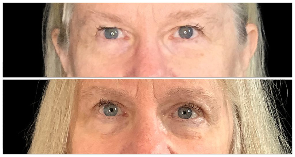 Close-up view of a person's eyes before and after a blepharoplasty procedure, showing differences in eyelid appearance and skin texture.