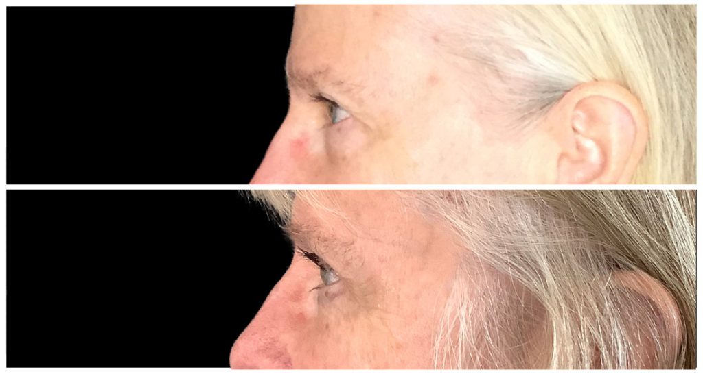 Side profile view of a person's eyes before and after a blepharoplasty procedure, showing changes in eyelid appearance.