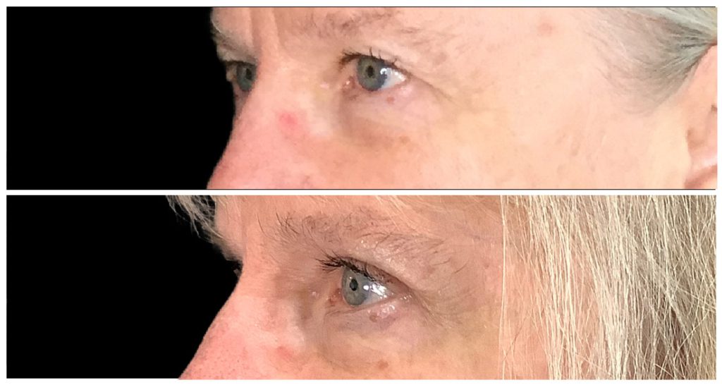 Close-up view of a person's eyes before and after a blepharoplasty procedure, showing differences in eyelid appearance and skin texture.