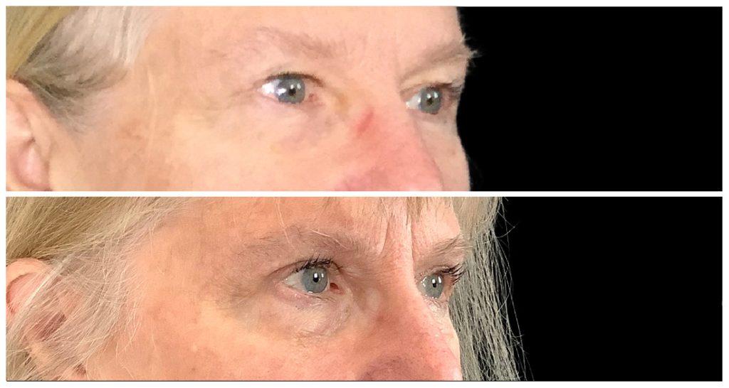 Close-up view of a person's eyes before and after a cosmetic procedure, showing differences in eyelid appearance and skin texture.