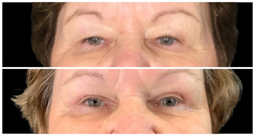 Before and after images of a person's eyes, showing changes in eyelid appearance and skin texture.