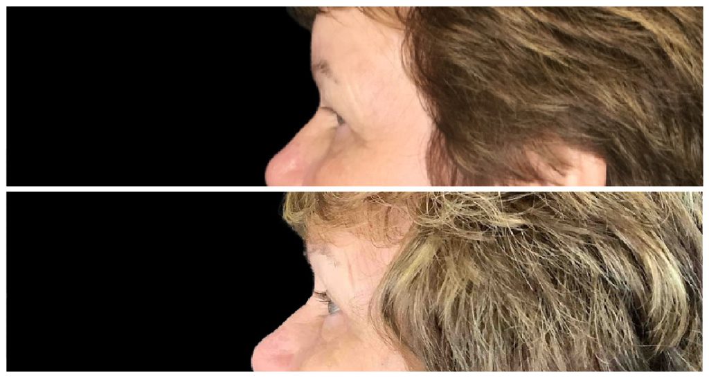 Before and after images showing the side profile of a person's eyes and eyelids, illustrating the effects of blepharoplasty.