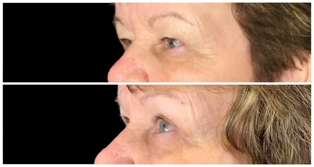 Before and after images showing the side profile of a woman's eyes, highlighting changes in eyelid appearance.