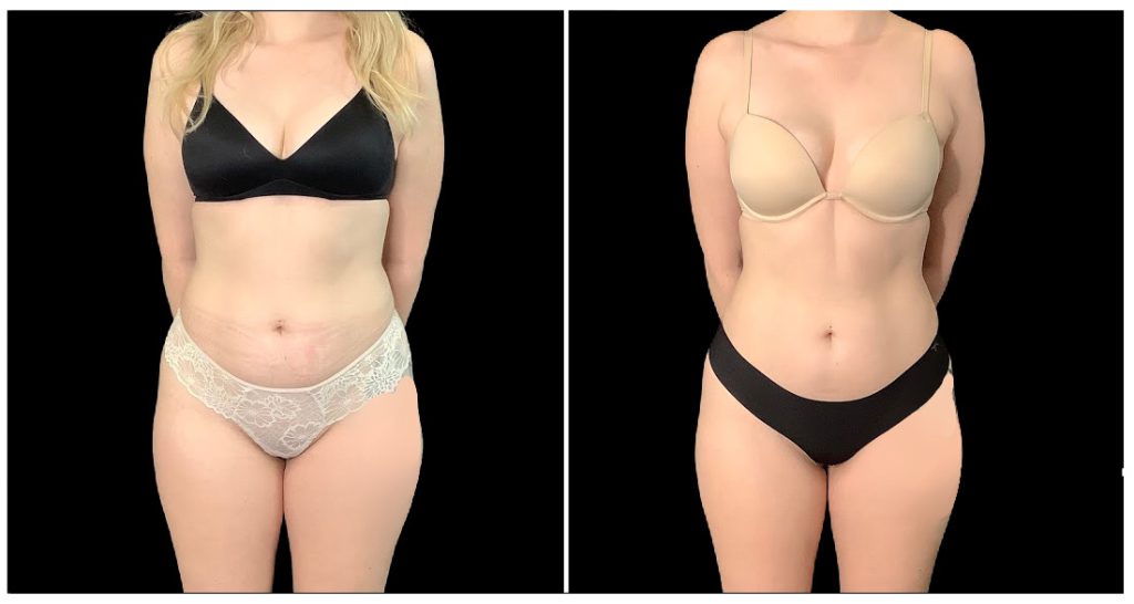 EMSCULPT® in London Ontario before and after result