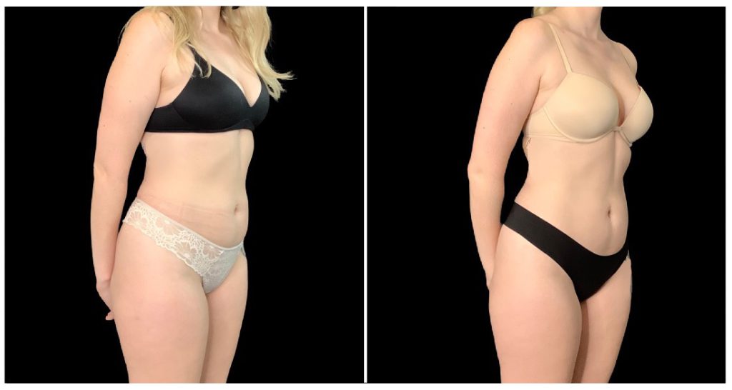 EMSCULPT® in London Ontario before and after result